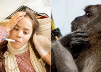 В РФ подтвержден первый случай оспы обезьян