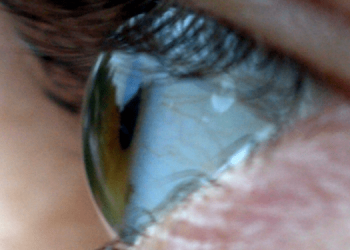 Имплант, который возвращает зрение ослепшим