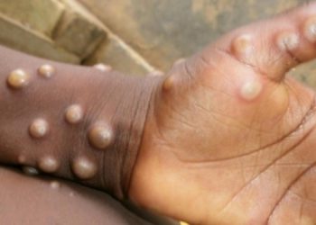 В Европе зафиксировали новый случай смерти от оспы