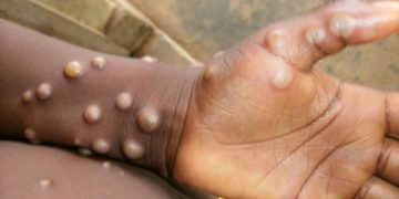 В Европе зафиксировали новый случай смерти от оспы