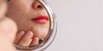 Почему появляются прыщи