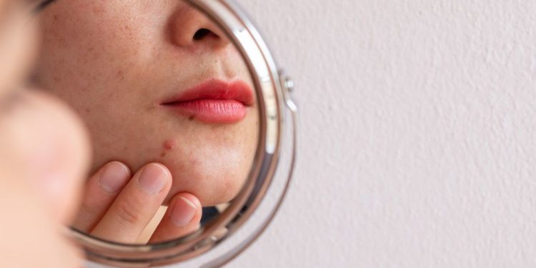 Почему появляются прыщи