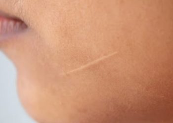 Ученые нашли способ избавиться от шрамов