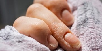 Какие заболевания можно диагностировать по ногтям