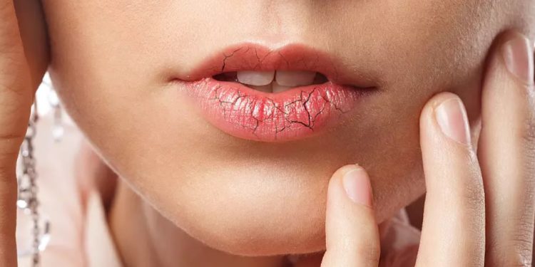 Швидке лікування герпесу на губах
